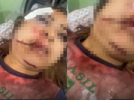 Mulher escapa da morte após ser brutalmente agredida em Várzea Grande
